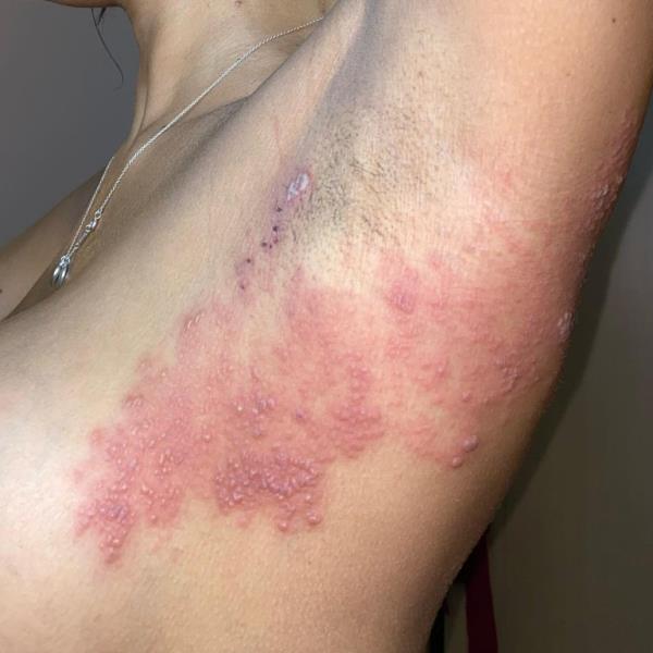 chanelle's skin