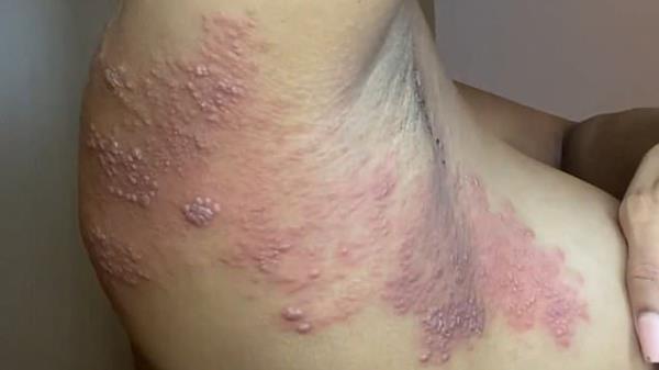 chanelle's skin
