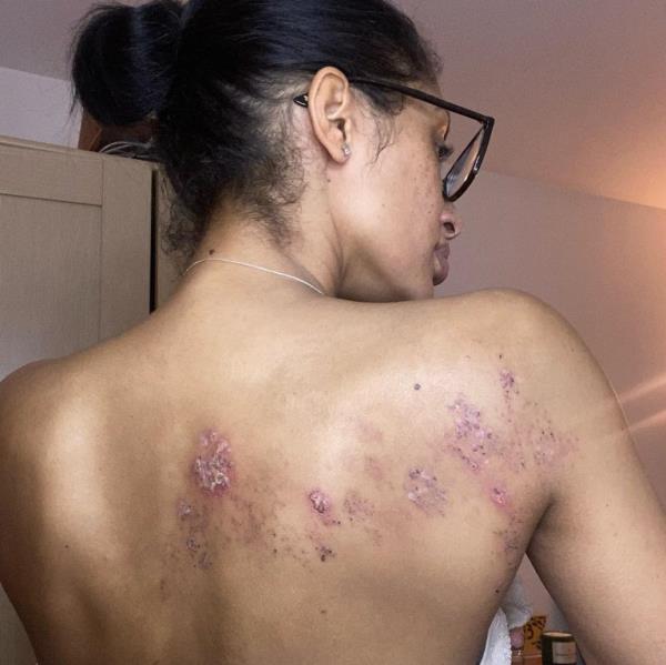 chanelle's skin