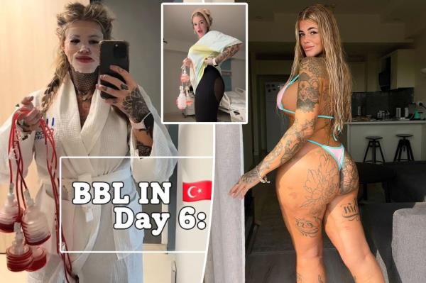 英国女性做了13次整形手术，第一次“死亡”后，她又得到了第二次BBL