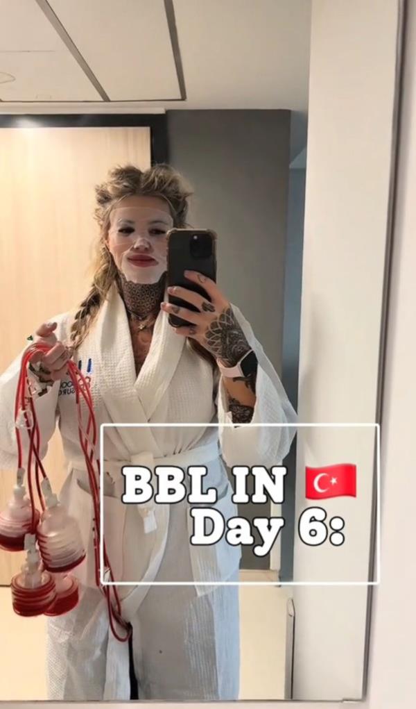 Scarlet Black, 28, from the UK, six days after her second BBL.