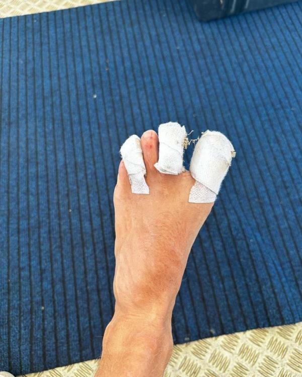 Colin Jost turned his foot injury into fodder for comedy segments during his 2024 Olympics coverage.