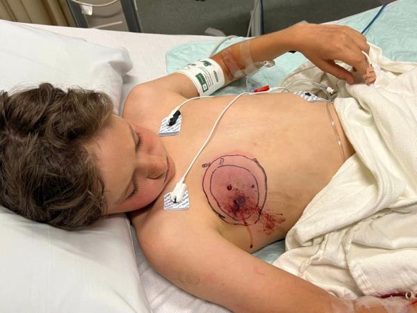 boy with snake bite in hospital