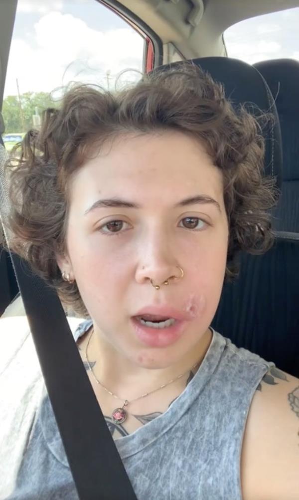 A co<em></em>ntent creator has warned a<em></em>bout the effects of popping your pimples after she developed a Staph infection from picking at her zit.</p>

<p>　　