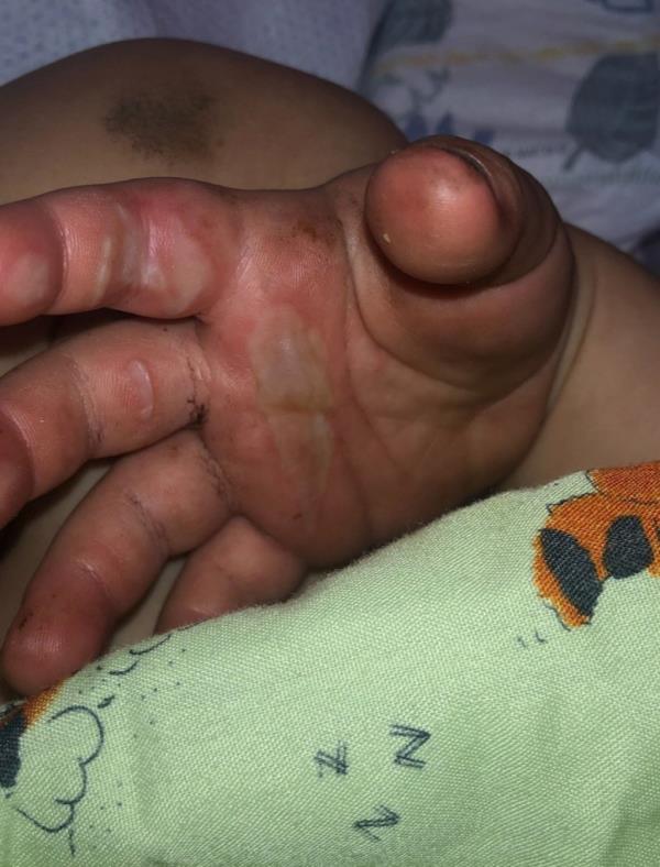 Finny's burned hand