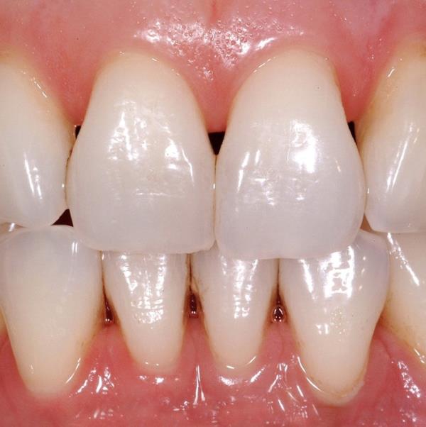 Co<em></em>ncerned a<em></em>bout black triangles in between your teeth? Here's what to do.