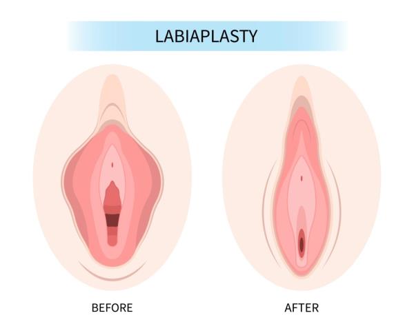 Before and after labiaplasty