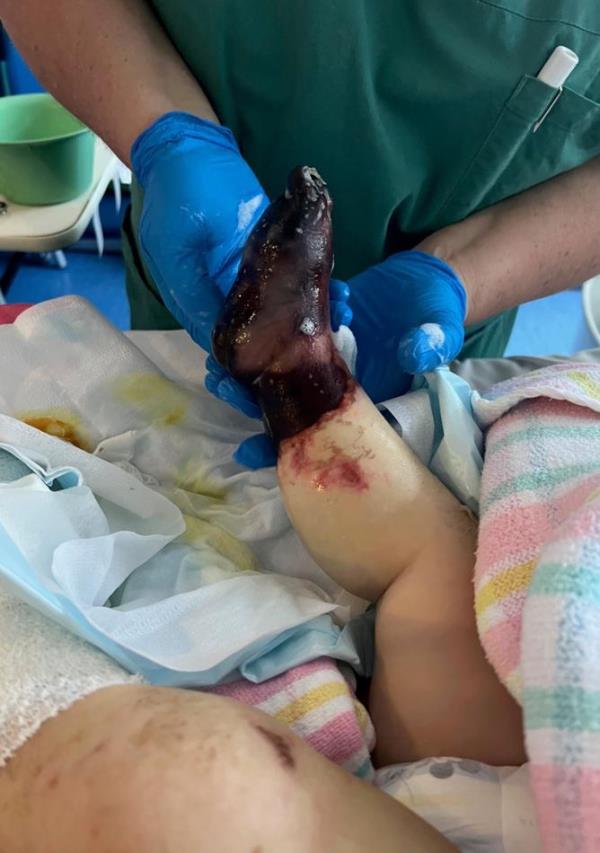 Fortunately, doctors were able to save Ryan’s life but unfortunately, he had to have his legs, feet and fingers amputated. 